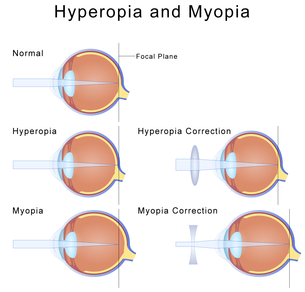 Hyperopia műtét - Hyperopia Age Treatment Forum