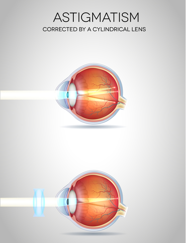 Astigmatism Eye Health Central