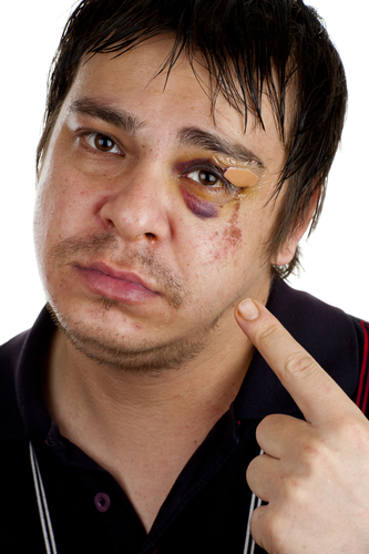 a black eye eye