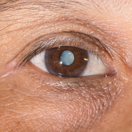 Mature Cataract