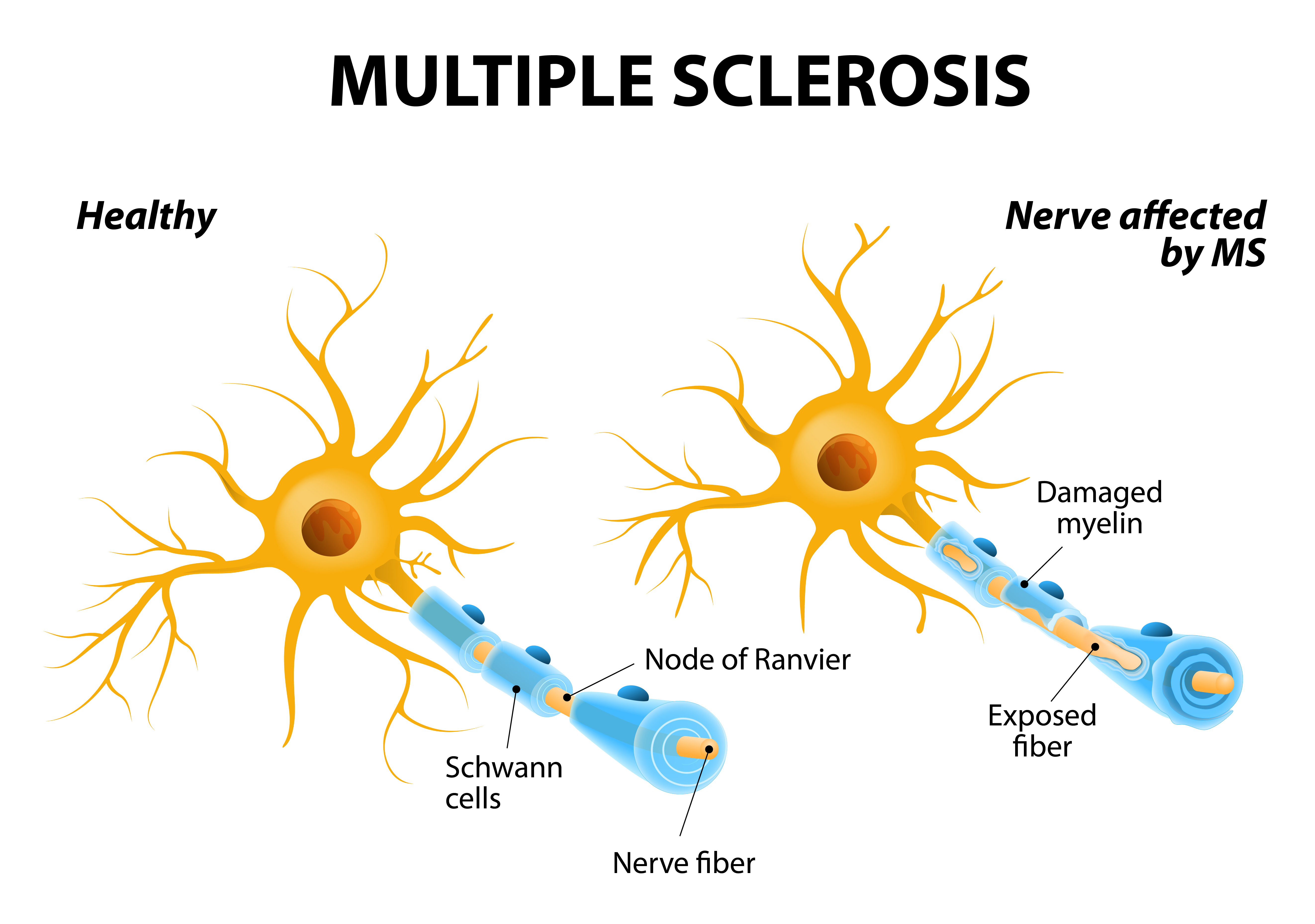 multiple sclerosis eye health central