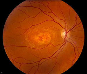 Stargardt Disease