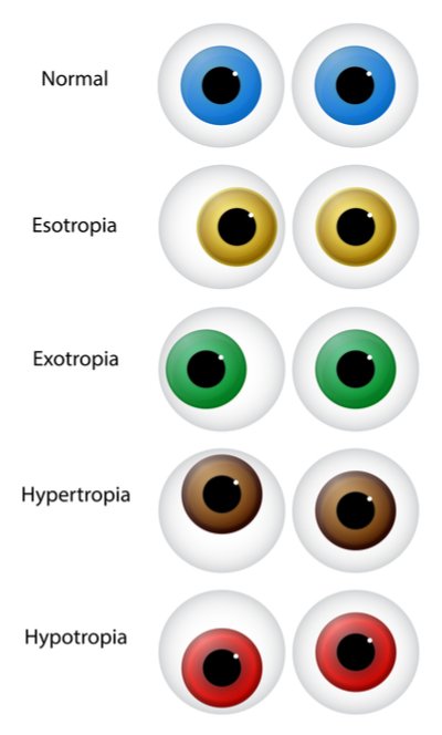 Strabismus
