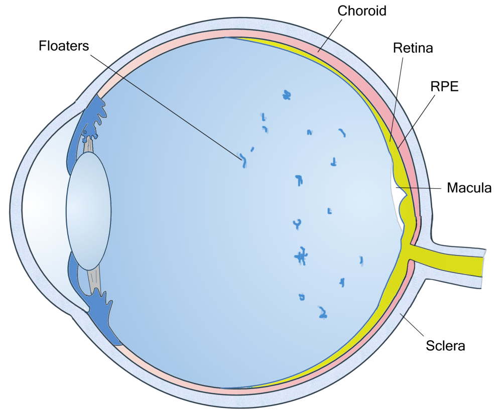 A Eye Floater? Eye Health Central