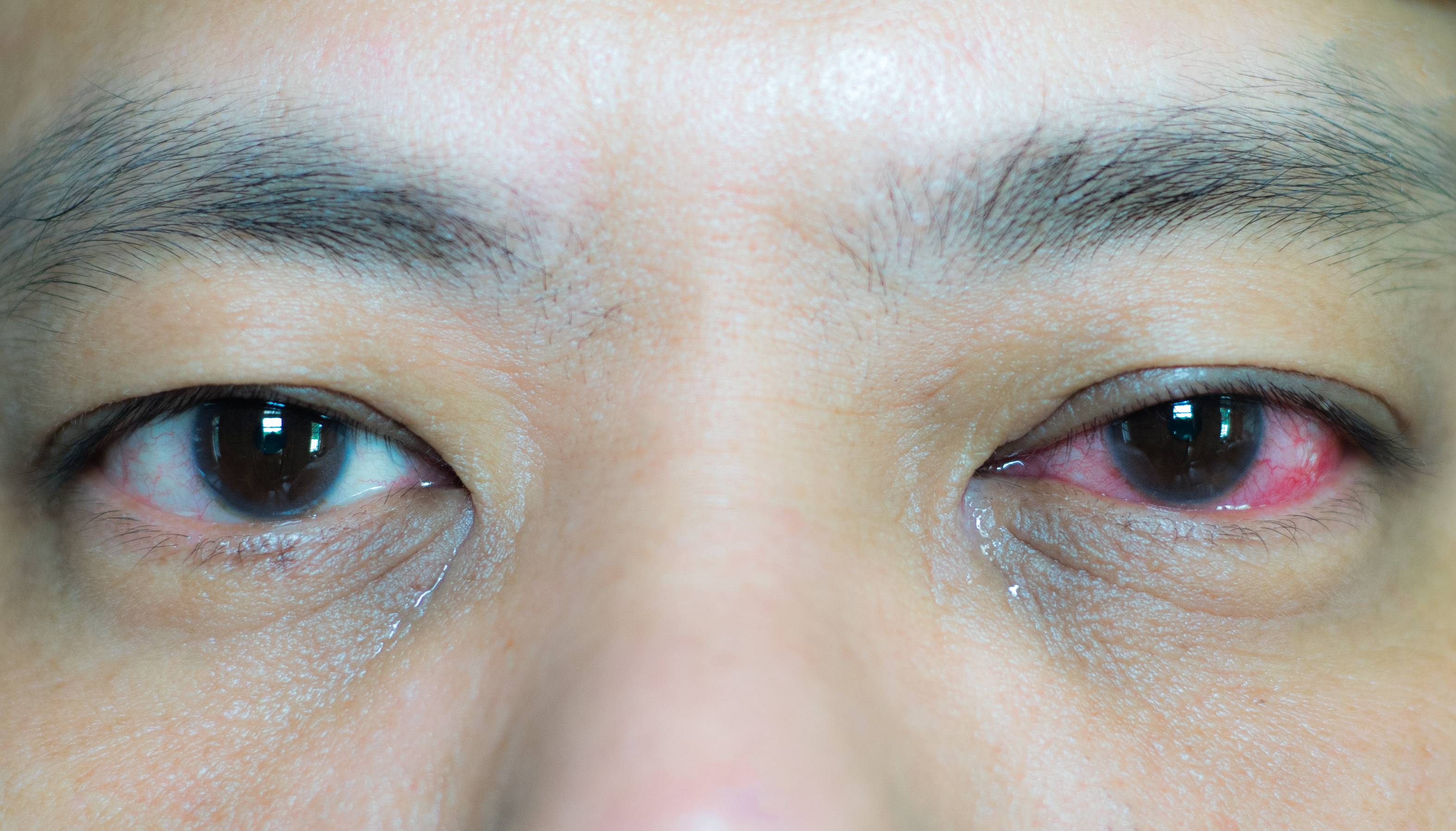 Conjunctivitis- Pink eye