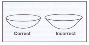 Are My Contact Lenses Inside Out Eye Health Central