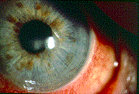 Allergic Conjunctivitis