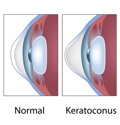 Keratoconus