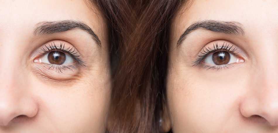 How to get Rid of Puffy Eyes & it's Causes