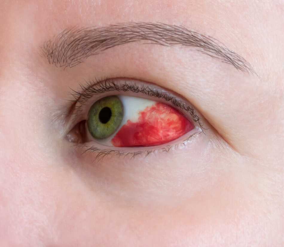 Subconjunctival Haemorrhages