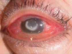 Corneal Ulcer